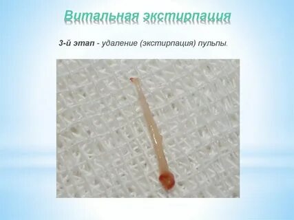 Экстирпация пульпы