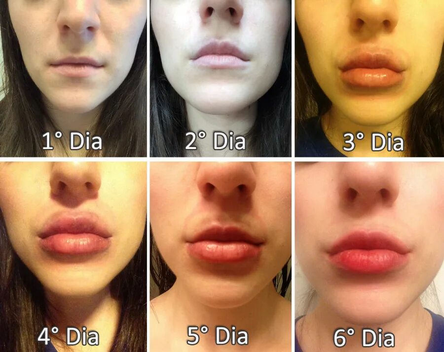 Скольки лет можно накачать губы. Синяки после увеличения губ. Увеличенные губы по дням.