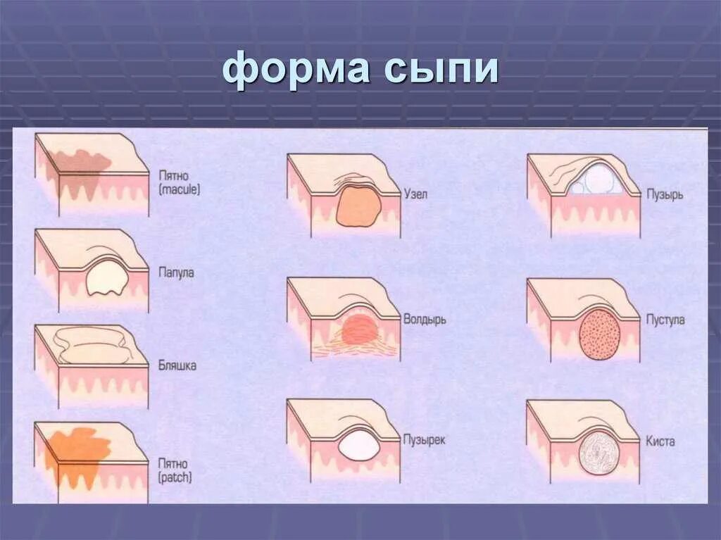 Первичные полостные элементы. Морфологические элементы сыпи папула. вторичные элементы сыпи ветряная оспа. вторичные морфологические элементы кожи лихенификация.