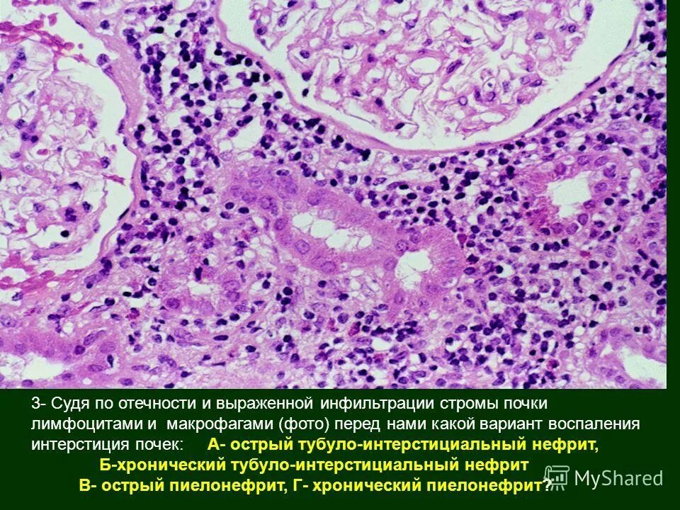 Рентгенологическими признаками гангрены легкого являются. Хронический активный вирусный гепатит микропрепарат. Острый тубулоинтерстициальный нефрит гистология. Гнойный менингит патанатомия. Выраженная инфильтрация.