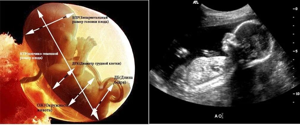 Размер плода на 19 неделе беременности УЗИ. УЗИ плода 19-20 недель беременности. Эмбрион на 19 неделе беременности УЗИ. УЗИ 20 недель беременности размер плода. Нормы плода 19 недель