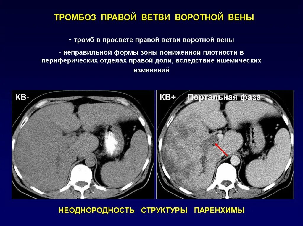 Тромбоз печеночной вены кт. Портальная Вена печени кт. Опухолевый тромбоз почечной вены кт. Тромб в воротной Вене на кт. Тромбоз почек