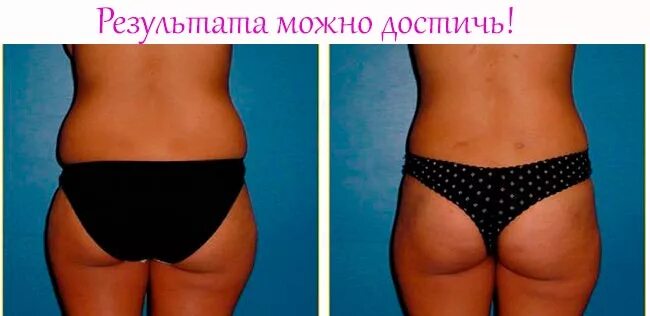 Жир на боках. Жир на пояснице и боках. Жир на боках у женщин