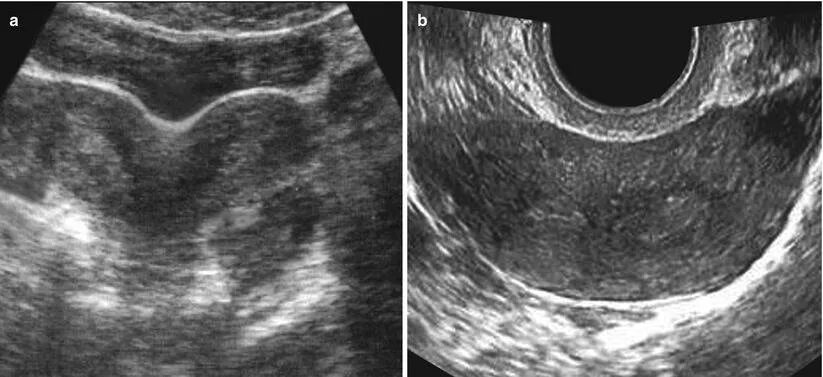 Связки матки схема. Удвоение матки две шейки. Узи признаки перфорации матки. Фиксирующий аппарат матки связки. Строение стенки маточной трубы анатомия.