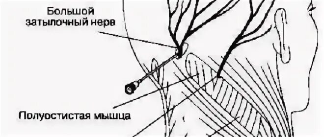 Невропатия затылочного нерва. Неврит большого затылочного нерва. Невралгия затылочного нерва код мкб. Невралгия затылочного нерва мкб 10.