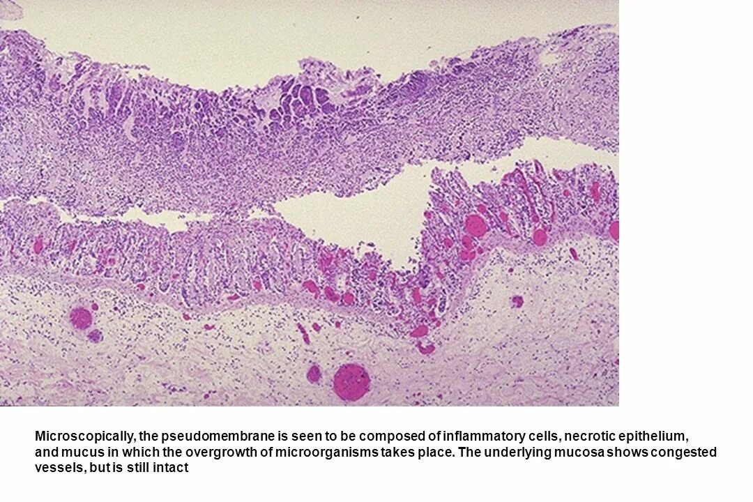 Псевдомембранозный энтерит. Стафилококковый язвенный энтерит микропрепарат. Дифтеритический колит патанатомия. Некроз толстой кишки гистология.