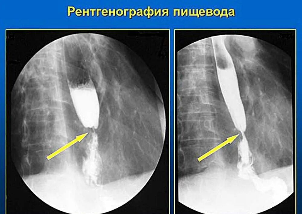 Контрастирование пищевода рентген. ГЭРБ стриктура пищевода. Рентгенодиагностика стриктур пищевода. Рентгенологические исследования пищевода с бариевой взвесью. Скопия пищевода желудка