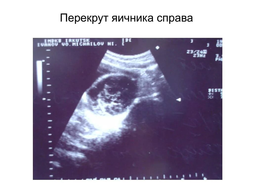 Перекрут придатков матки. Перекрут опухоли яичников узи. перекрут кисты яичника узи. перекрут ножки кисты яичника узи.