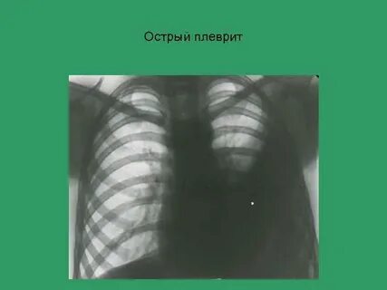 Острый плеврит