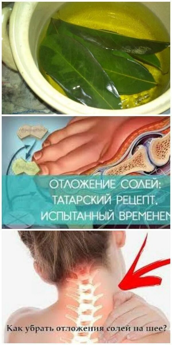 Как бороться с отложением солей. Отложение солей в шейном отделе.