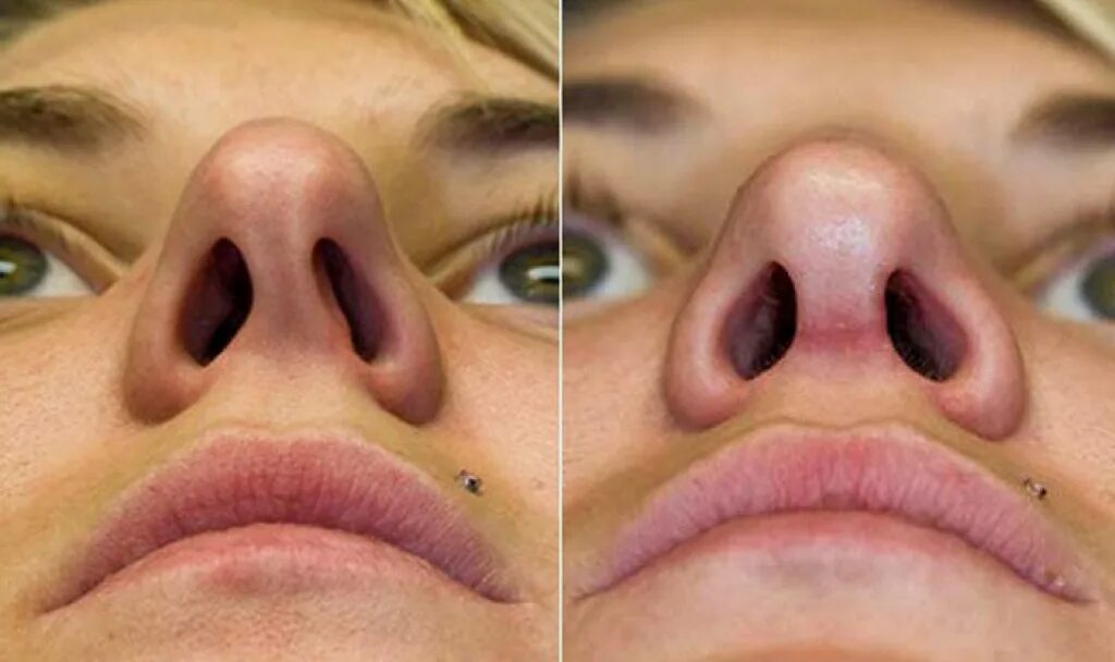 Септопластика искривление носовой перегородки. Выправление перегородки носа лазером. Перфорация носовой перегородки мкб 10. J34.2 - смещенная носовая перегородка. Какие операции делают на носу