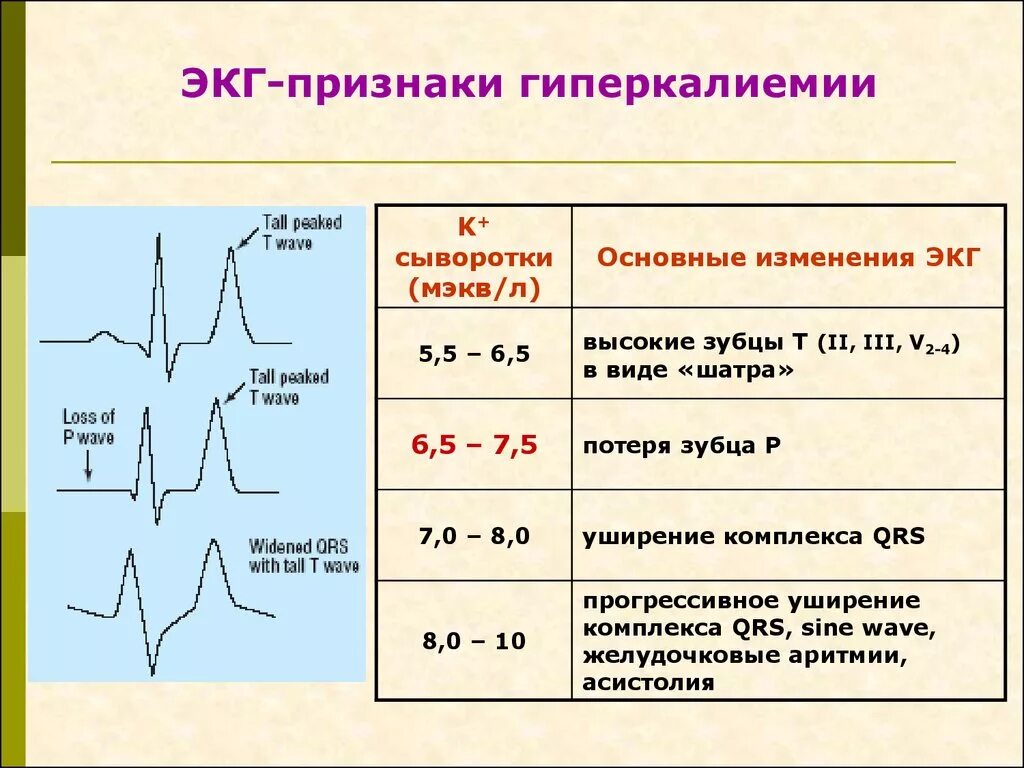 Признаки t r. Гиперкалиемия на экг. экг критерии гиперкалиемии. признаки гиперкалиемии на экг. экг при гиперкалиемии и гипокалиемии.