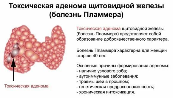 Как удаляют щитовидную железу узел Тиреотоксикоз причины появления, при каких заболеваниях возникает, диагностика