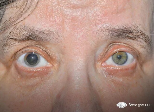 Почему глаз расширяется. Экзофтальм анизокория. Миоз экзофтальм мидриаз. Анизокория карие глаза. Птоз мидриаз экзофтальм.