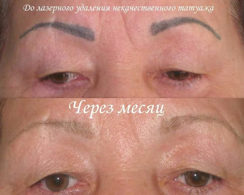 выведение тату бровей лазером. сведение татуажа бровей лазером. выведение татуажа лазером. татуаж бровей заживление.