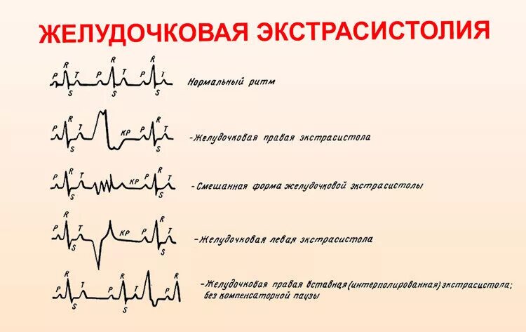 Желудочковые экстрасистолы на ЭКГ. Нарушения ритма на ЭКГ экстрасистолы. ЭКГ монотопные желудочковые экстрасистолы. Ранние желудочковые экстрасистолы на ЭКГ.