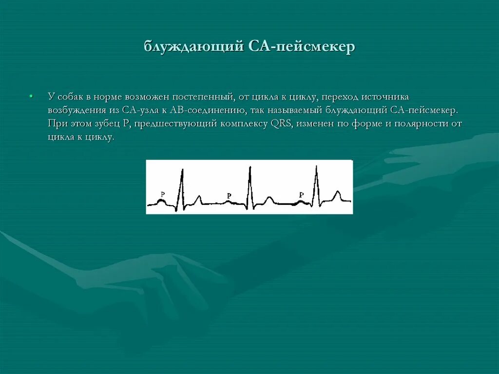 Пейсмекер. Блуждающий пейсмейкер. синоатриальный пейсмейкер. блуждающий пейсмейкер это в ветеринарии. пейсмекер-индуцированная тахикардия.