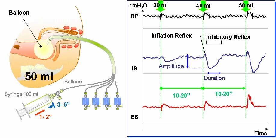 Профилометрия. Объективизация. Профилометрия трубопроводов. Профилометрия в проктологии. Лазерная профилометрия.