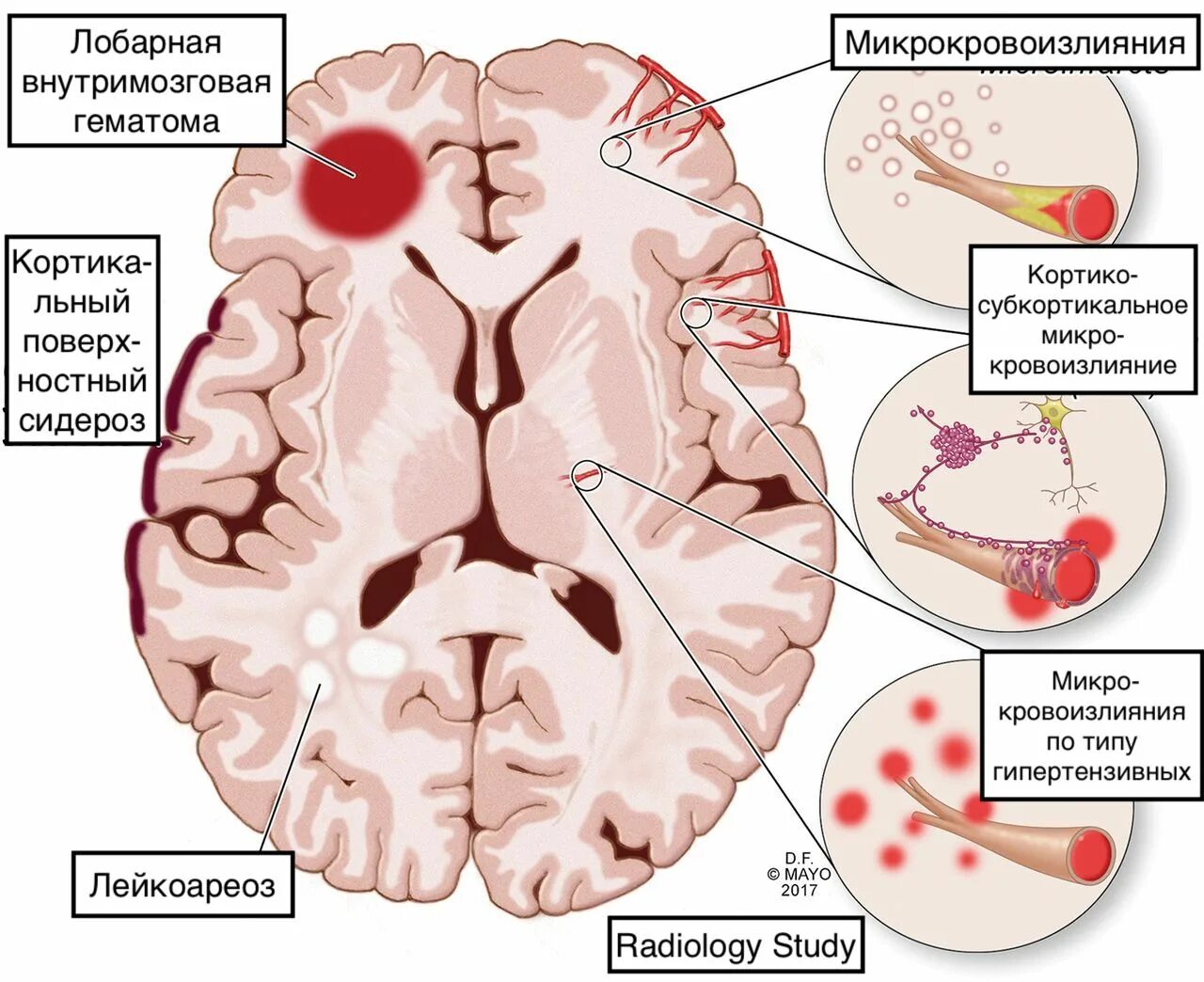 Ангиопатия сосудов головного. Амилоидная микроангиопатия церебральная. Микроангиопатия сосудов головного мозга симптомы. Церебральная микроангиопатия головного мозга кт. Амилоидоз головного мозга.