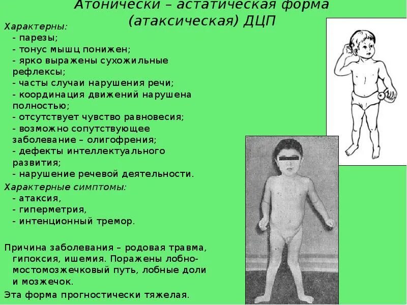 Дцп атонически астатическая. Атонически астеническая форма ДЦП. Детский церебральный паралич атонически-астатическая форма. Формы ДЦП атонически-астатическая форма. Характеристики атонически-астатической формы ДЦП.