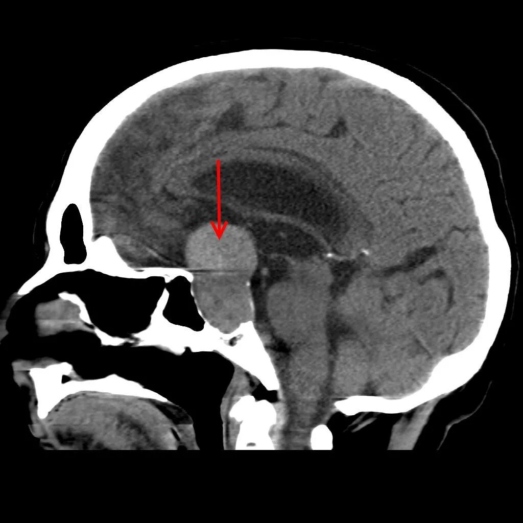 Формирующееся турецкое седло в головном мозге
