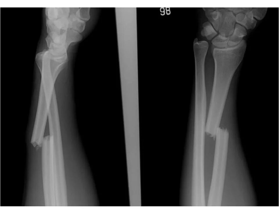 Смещение кости на руке без перелома. Перелом костей предплечья рентген. Рентген перелома кости предплечья. Перелом диафиза лучевой кости рентген. Рентген перелом диафиза кости.