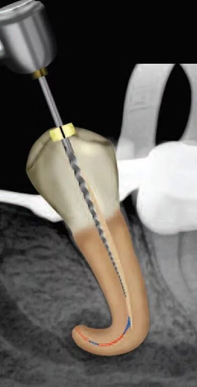 Удаление нерва под микроскопом File:Pulp tissue removed during endodontic therapy by a size 20 broach