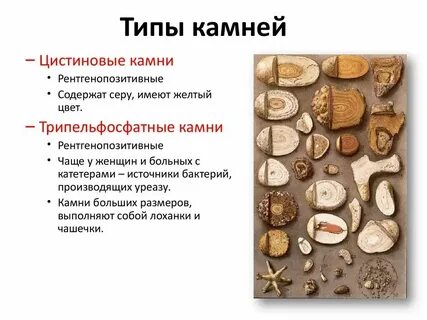 Виды конкрементов