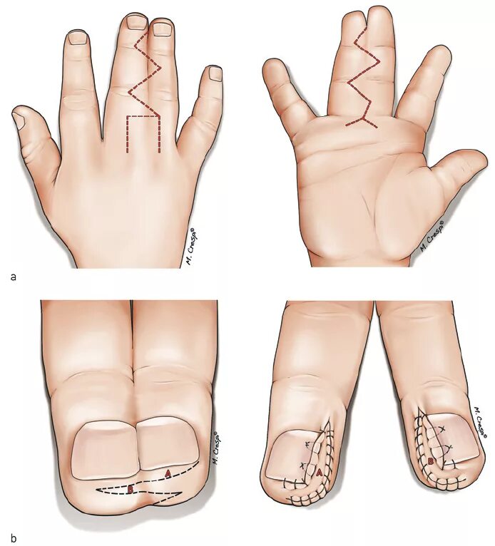 Брахидактилия синдактилия. Синдактилия пальцев стопы операция. Синдактилия пальцев рук операция. Костная форма синдактилии. Операция на большом пальце руки