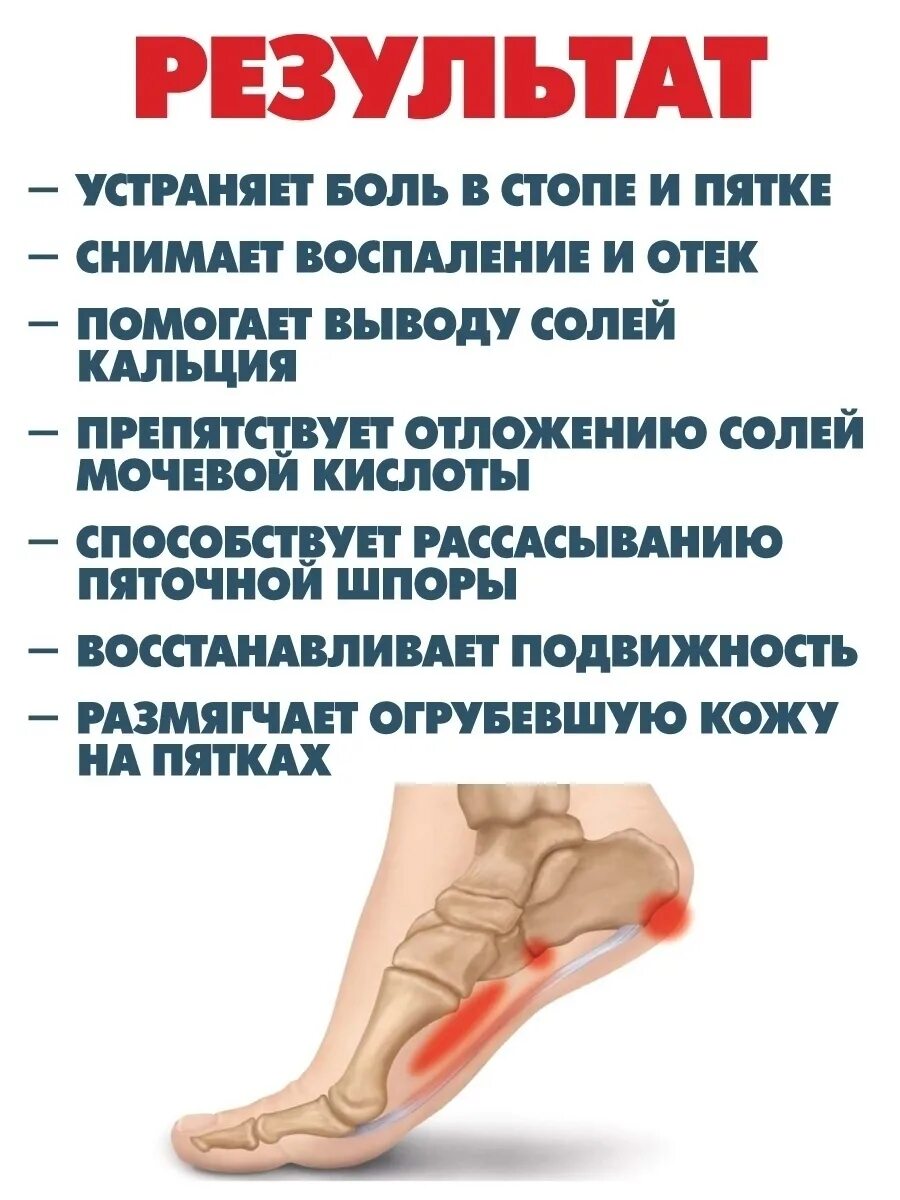 Что такое шпора и как ее лечить