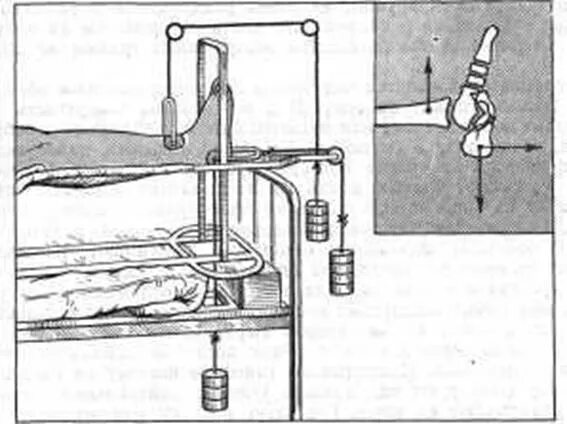 Перелом большеберцовой кости скелетное вытяжение. Скелетное вытяжение за пяточную кость. Вытяжение кости при переломе голени. Скелетное вытяжение за пяточную кость. Вытяжение кости при переломе.