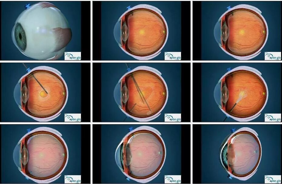 Глазная операция глаукомы. Отслойка сетчатки катаракта. Отслоение сетчатки глазное дно. Пресбиопия, глаукома, катаракта, макулодистрофия. Миопизирующая катаракта.