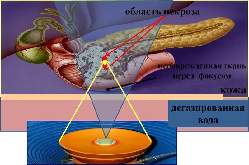 Абляция миомы. Абляция миомы