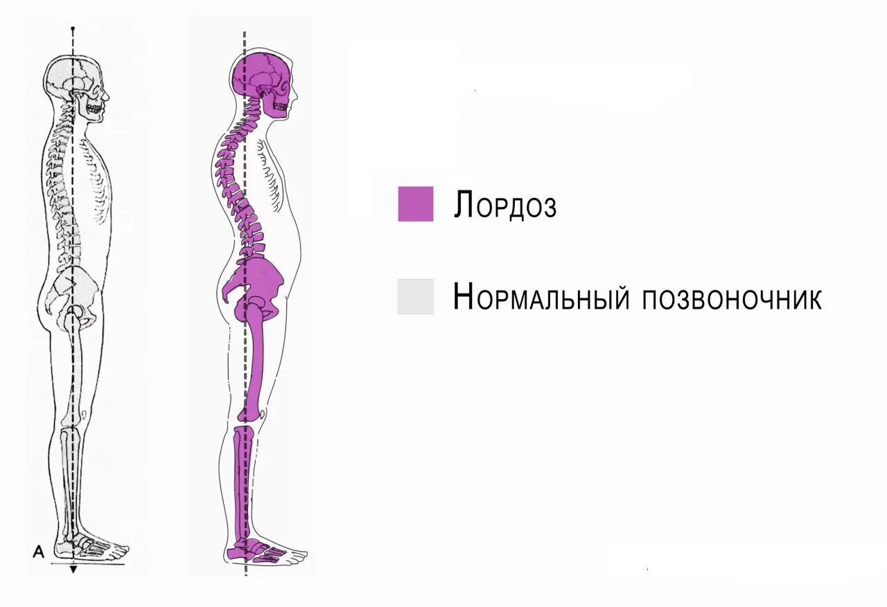 Нормальная поясница. Нормальный лордоз поясничного отдела позвоночника. Сглажен лордоз в поясничном отделе позвоночника. Лордоз грудного отдела позвоночника. Патологический лордоз поясничного отдела позвоночника что это такое.