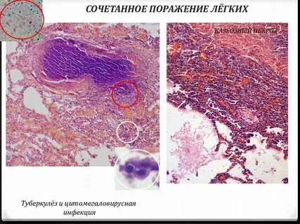 Туберкулез легких при вич