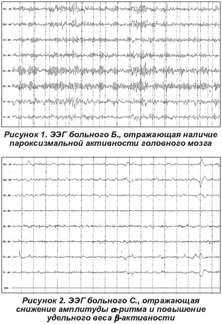 Пароксизмальная ээг. Пароксизмальная активность головного мозга на ЭЭГ. Пароксизмальная активность головного мозга у детей на ЭЭГ. ЭЭГ график. Виды пароксизмальной активности на ЭЭГ.