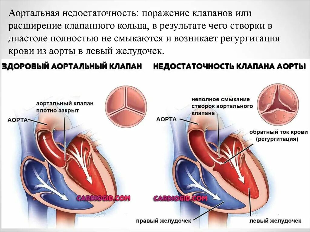 Аортальная недостаточность порок сердца. Недостаточность клапана аорты 2 степени. Регургитация 3 степени аортального клапана. Аортальная недостаточность. Порок аортального клапана.