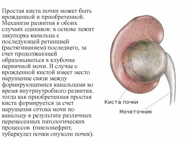 Киста в почке лечение у взрослых женщин. Гигантская киста почки.