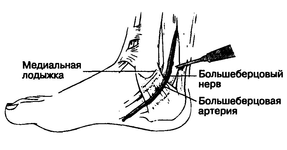 Туннельная невропатия стопы. Туннельный синдром большеберцового нерва. Блокада общего малоберцового нерва. Блокада большеберцового нерва техника.