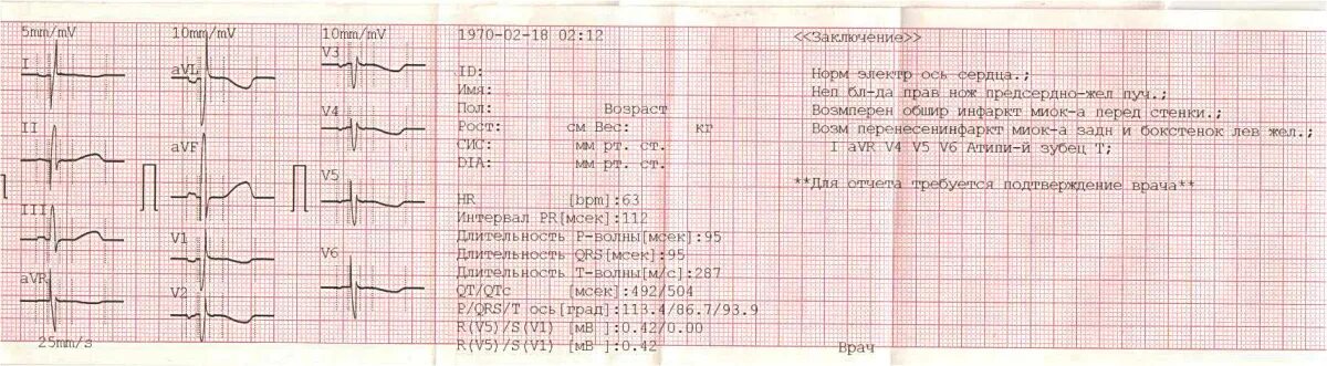 Расшифровка ЭКГ показатели нормы. QRS норма ЭКГ. Ось QRS норма ЭКГ. Нормы ЭКГ У взрослых таблица. Тяжелое экг