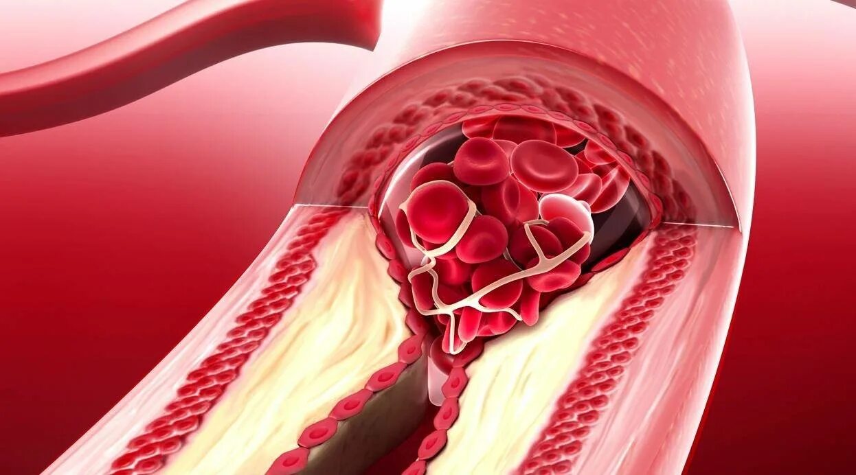 Чистка тромба. Коронарные сосуды сердца бляшка. Эмболия коронарных артерий. Кальцификация коронарных артерий.