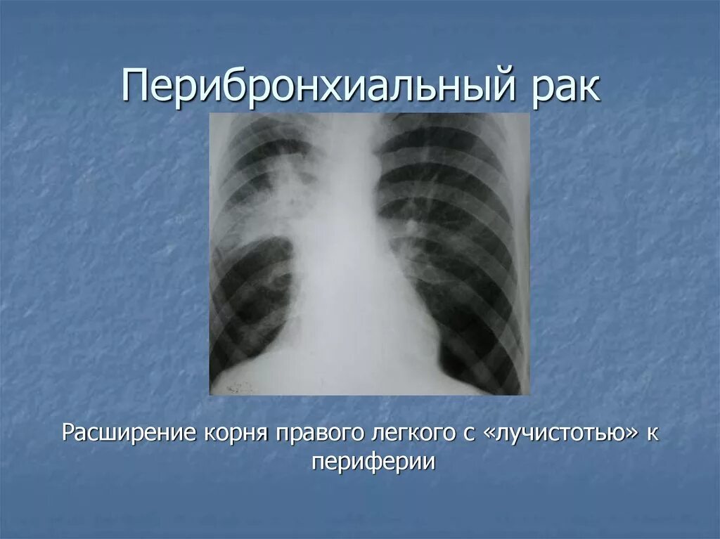 Центральное образование правого легкого рентген. Перибронхиальная опухоль. Образование корня легкого. Перибронхиально Узловая форма. Центральный рак правого