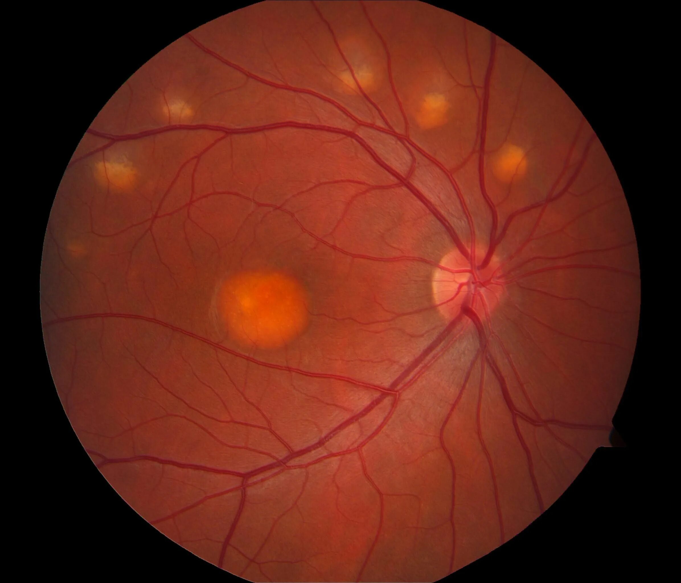 Болезнь глазного дна. Астроцитарная гамартома зрительного нерва. Экссудативная отслойка сетчатки. Пигментный ретинит сетчатки.
