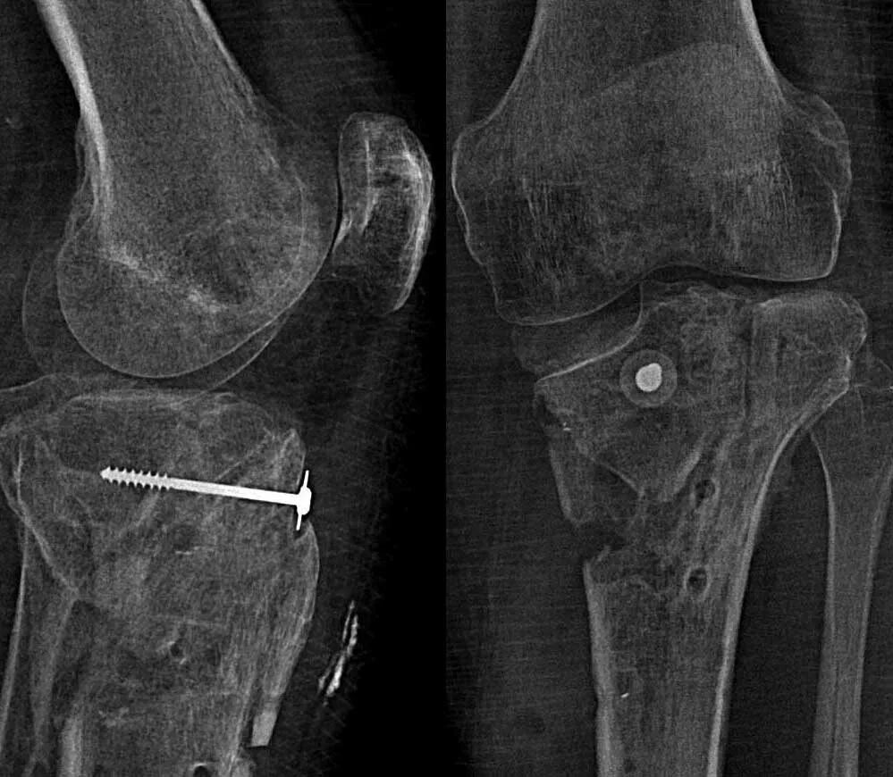 Импрессионный перелом мыщелков большеберцовой кости. Остеосинтез мыщелка большеберцовой кости. Импрессионный перелом мыщелка кт. Импрессионный перелом мыщелка большеберцовой кости мрт.