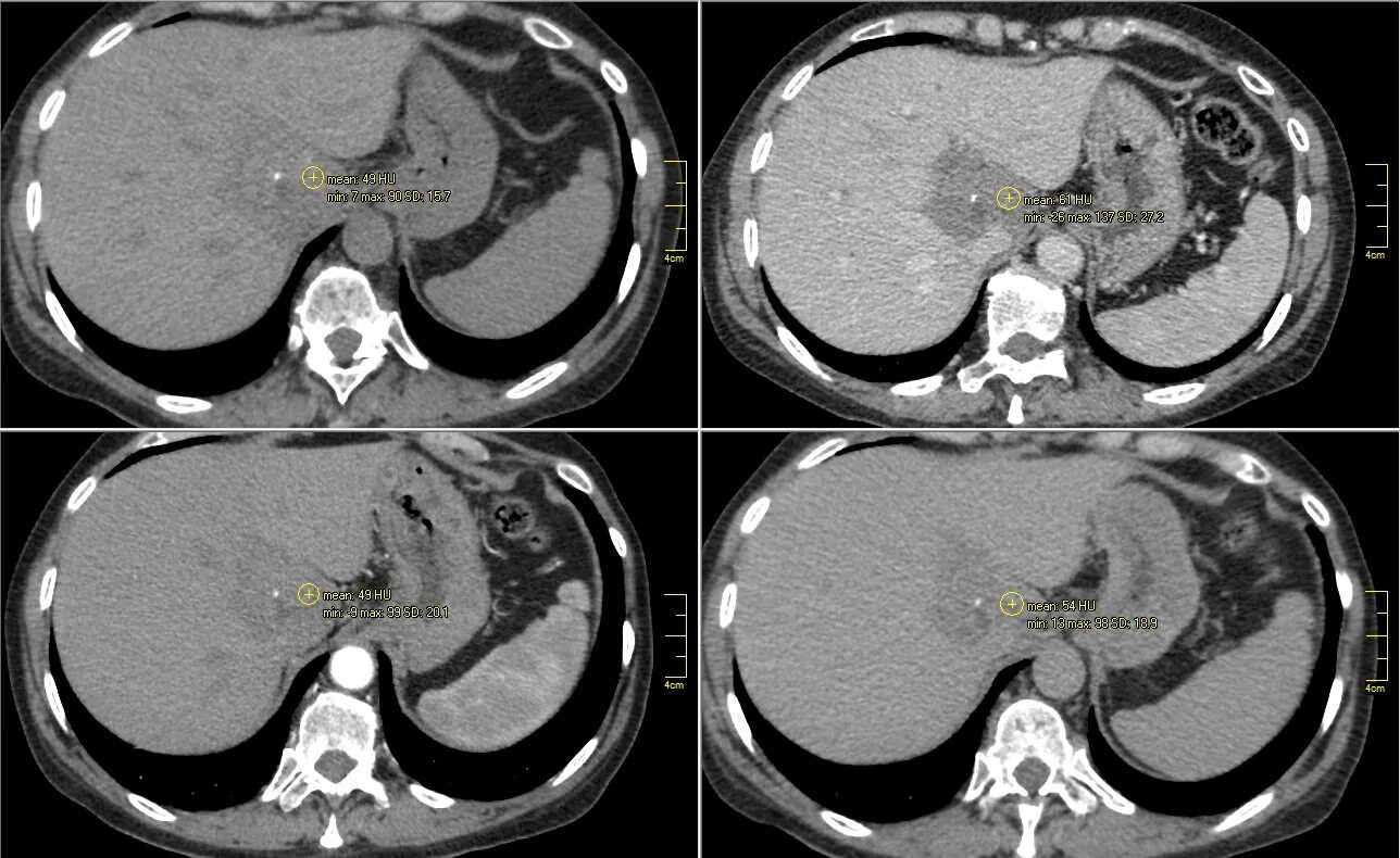 Кт метастазы печени контрастирование. Усиленная кт. Кровь после кт