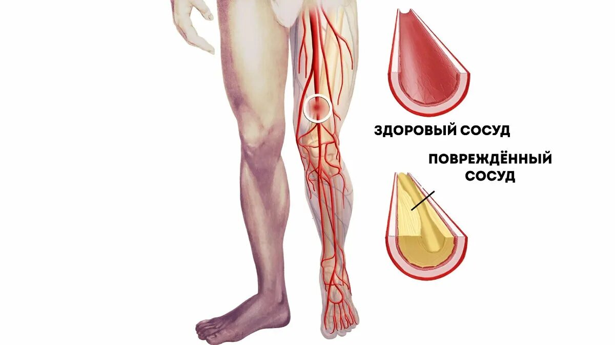 Повреждение сосудов конечностей. Повреждение сосудов конечностей