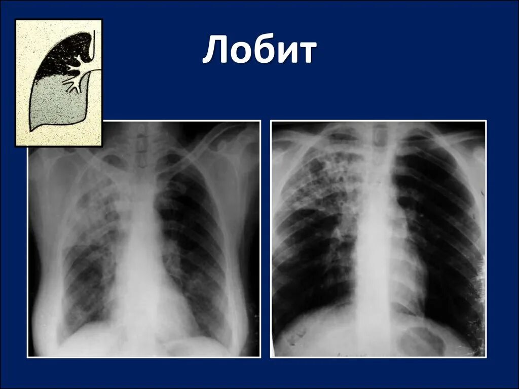 Лобить. Инфильтративный туберкулёз инфильтраты. Рентген инфильтративного туберкулеза легких. Инфильтративный туберкулез рентген. Инфильтративный туберкулез на кт.