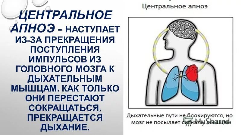 внутриротовые устройства от храпа. механизм происхождения соплей. апноэ кишлак осу. синдром ночного апноэ. отсутствие дыхания называется.