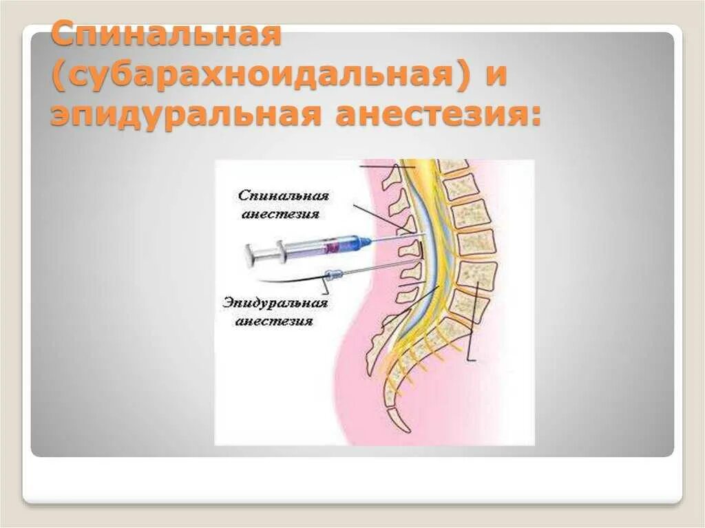 Эпидуральная спинная. Субарахноидальное пространство для спинальной анестезии. Эпидуральная анестезия дерматомы. Субарахноидальное пространство анестезия. Эпидуральная и субарахноидальная анестезия.