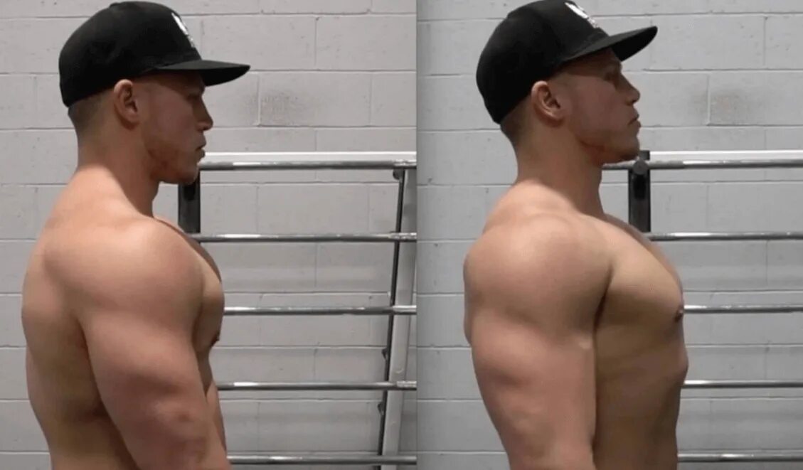 Round shouldered. Round shoulders.